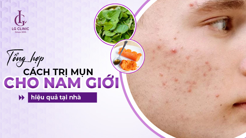 Cách trị mụn cho nam giới tại nhà