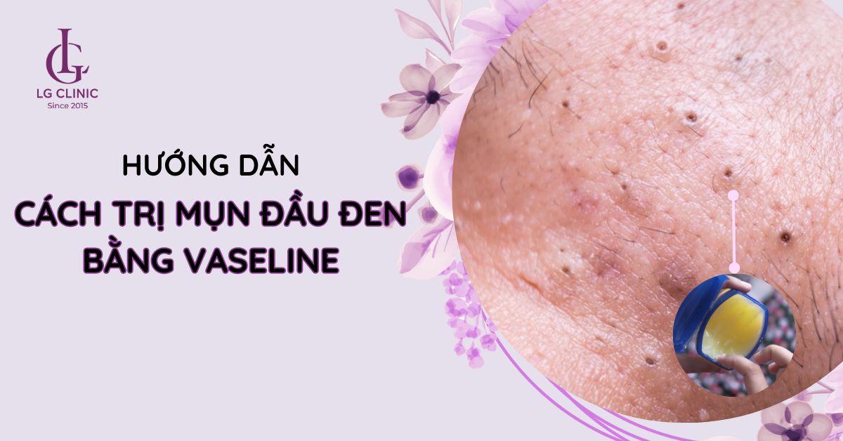 Hướng dẫn cách trị mụn đầu đen bằng vaseline đơn giản