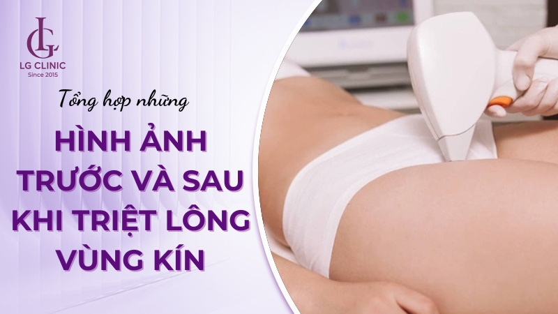 Hình ảnh sau khi triệt lông vùng kín