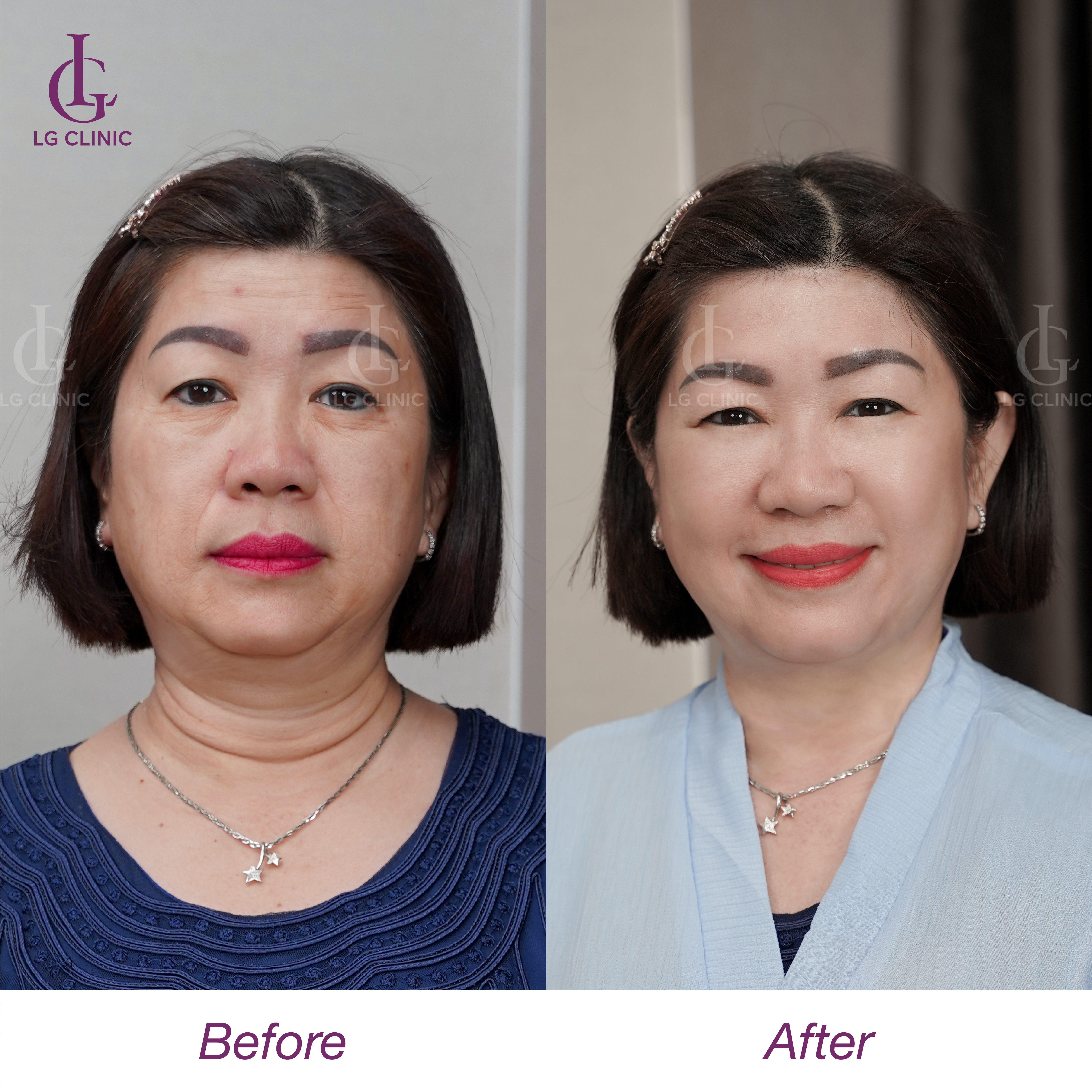 trước và sau khi căng chỉ megacell