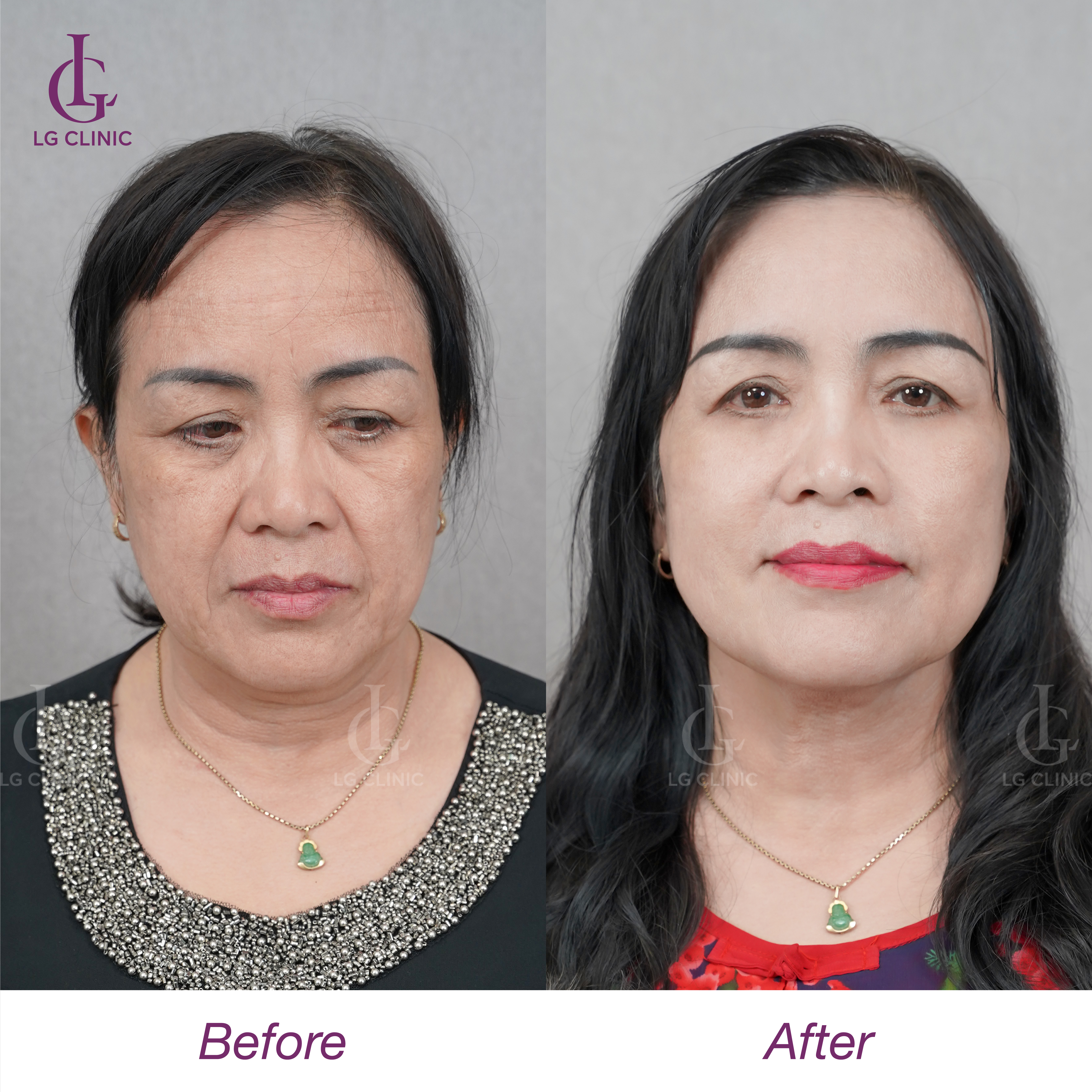 trước và sau khi căng chỉ megacell