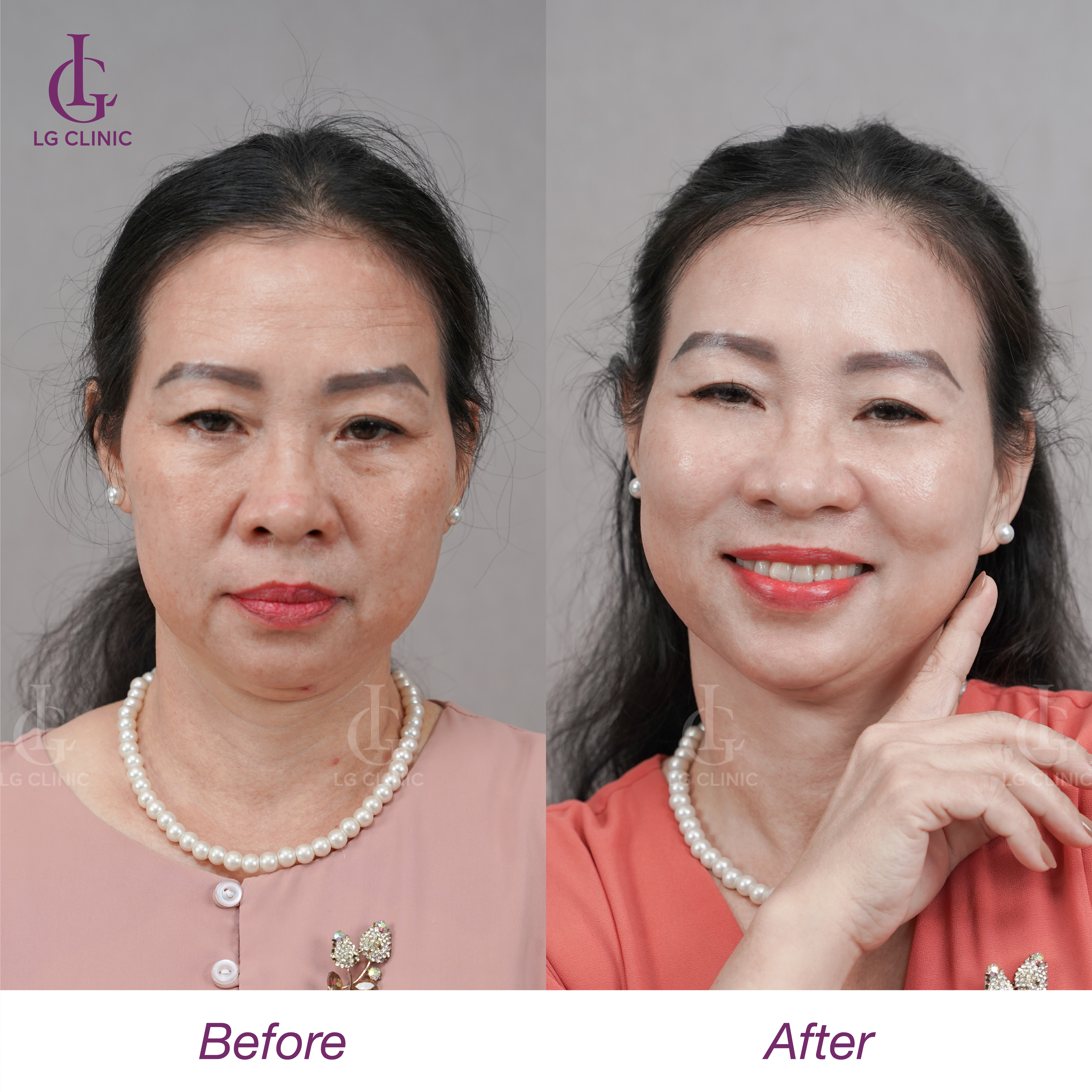 trước và sau khi căng chỉ megacell