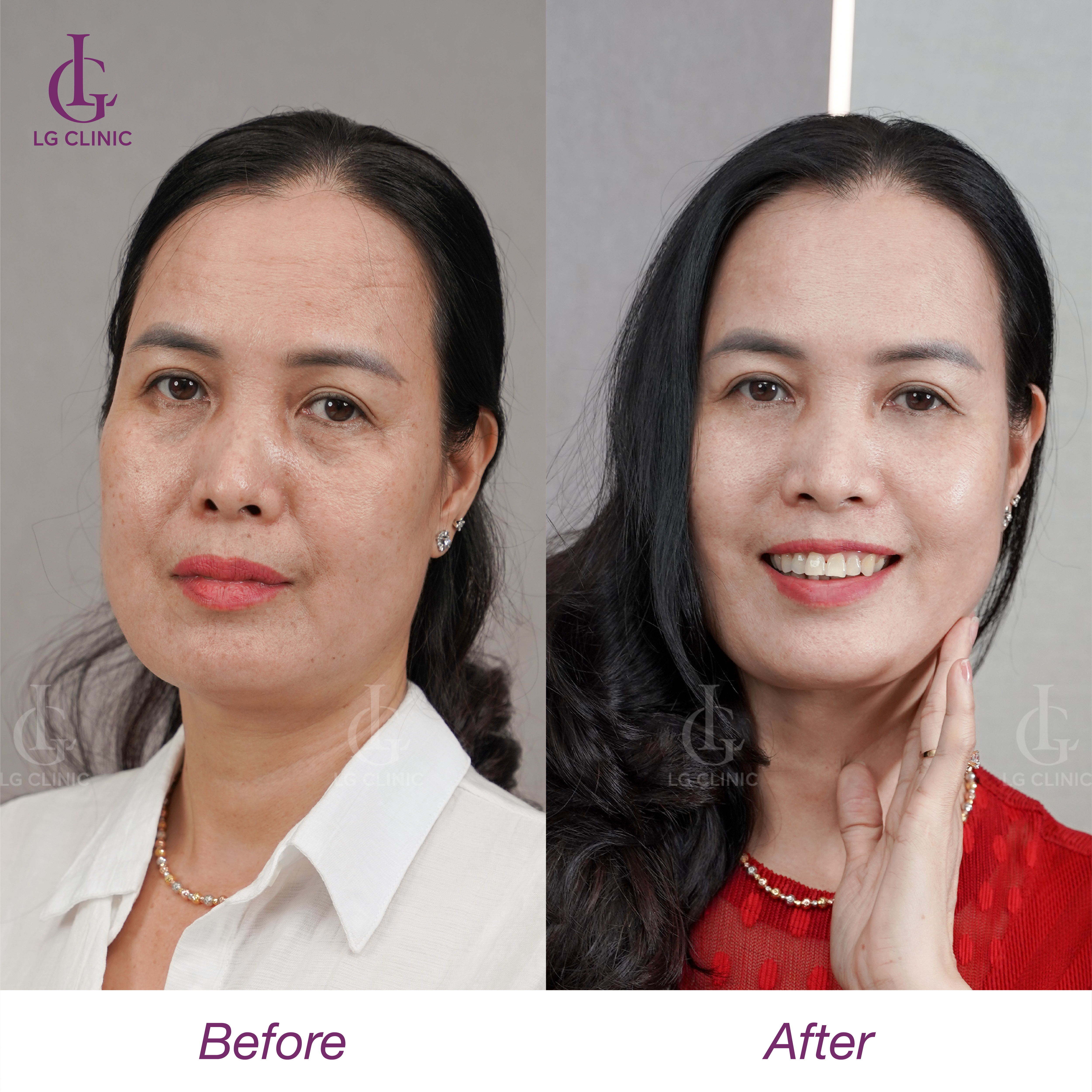 trước và sau khi căng chỉ megacell