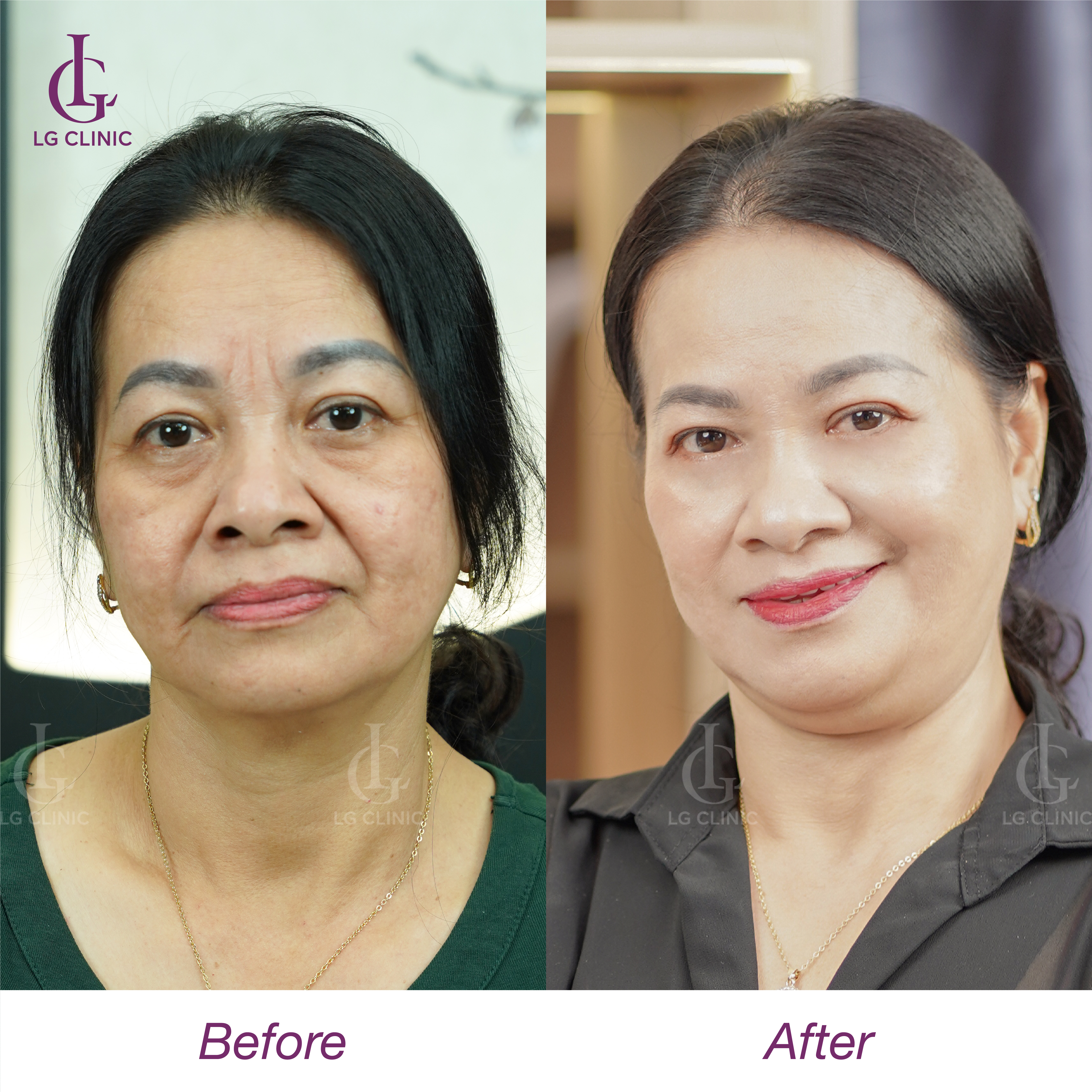 trước và sau khi căng chỉ megacell