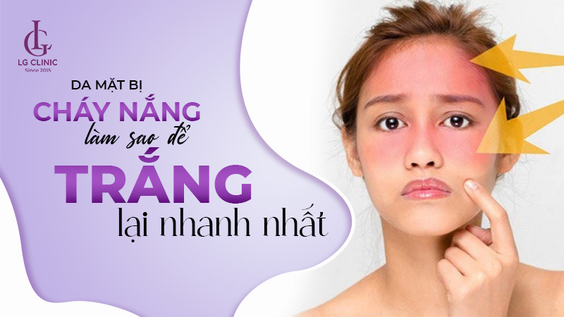 da mặt bị cháy nắng làm sao để trắng lại