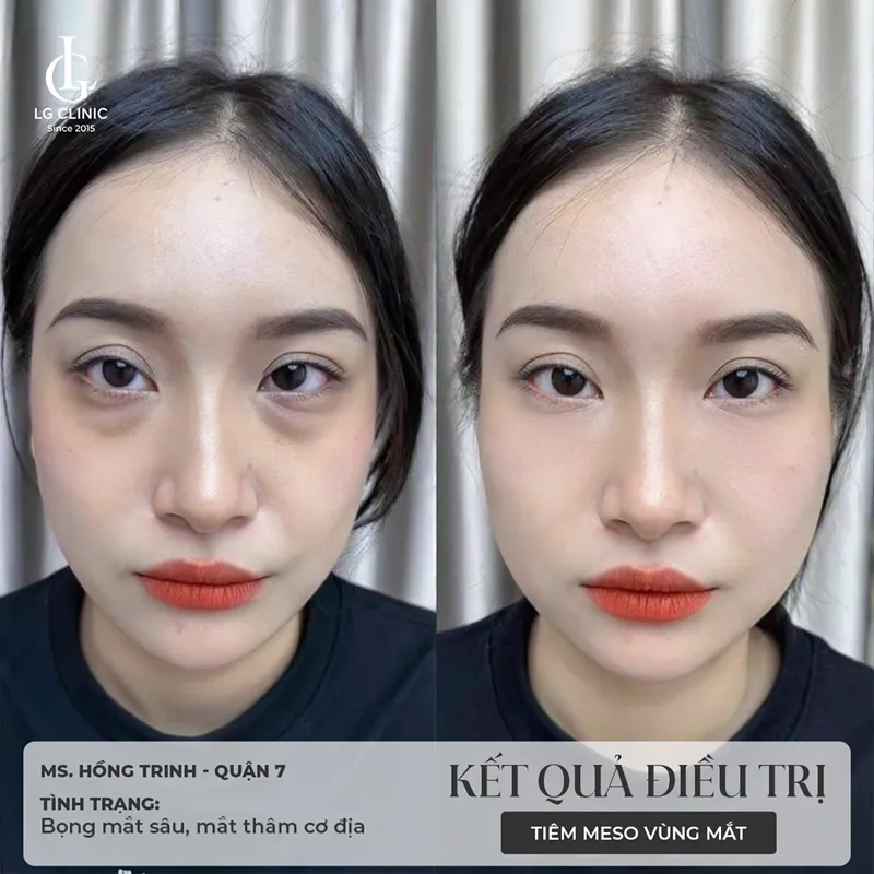 Hình ảnh tiêm bắp meso 1