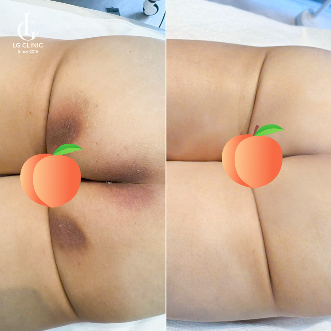 hình ảnh trị thâm mông nam - trị thâm khe mông
