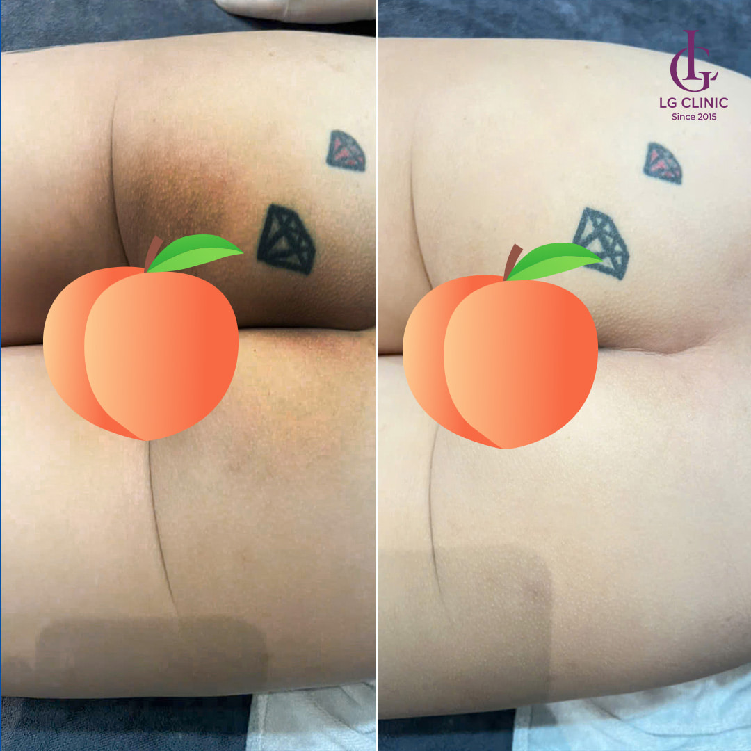 hình ảnh trị thâm mông nam