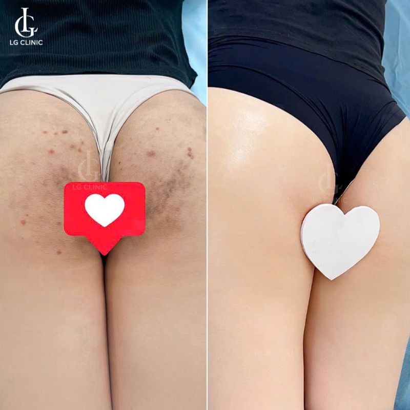 hình ảnh trị thâm mông bằng laser