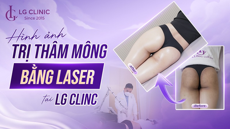hình ảnh trị thâm mông bằng laser