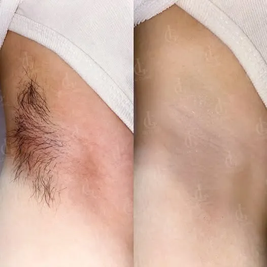 Hình ảnh ba ưu đãi triệt lông 03