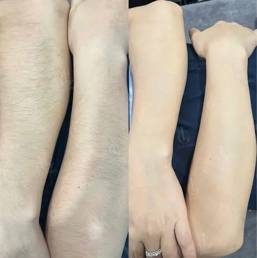 Hình ảnh ba ưu đãi triệt lông 04