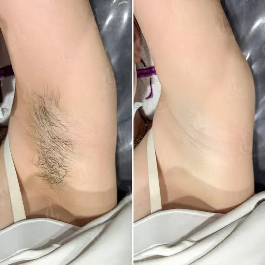 Hình ảnh ba ưu đãi triệt lông 06