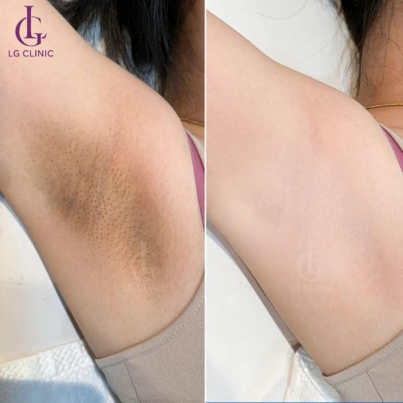 Trước sau trị thâm nách 1
