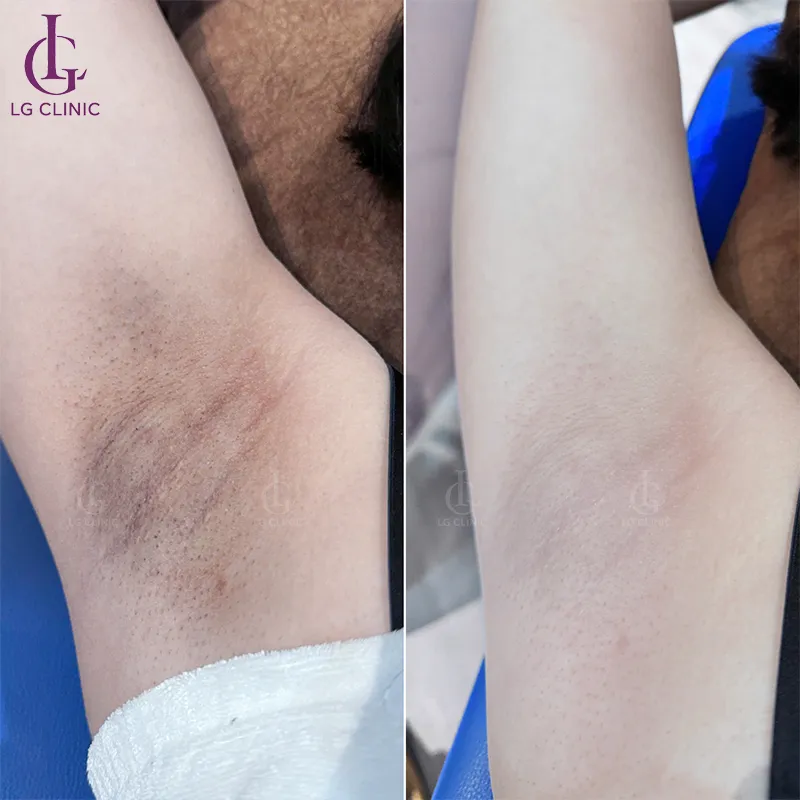 Trước sau trị thâm nách 2