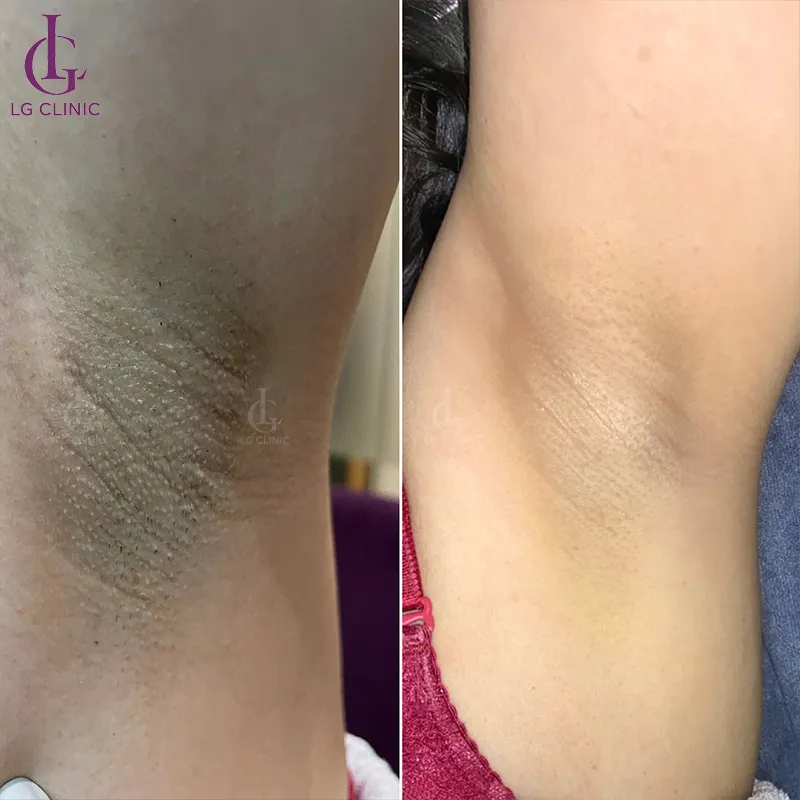 Trước sau trị thâm nách 5