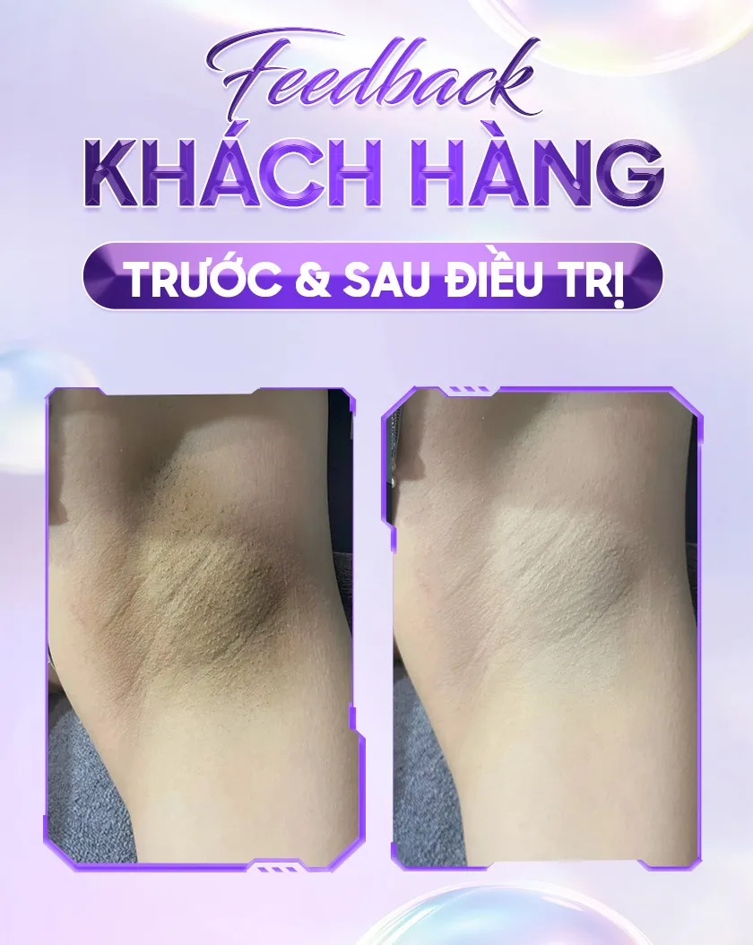 Ba ưu đãi trị thâm 01 1