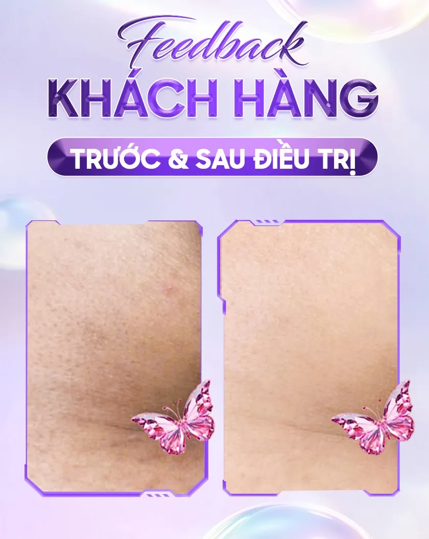 Ba ưu đãi trị thâm 02 1