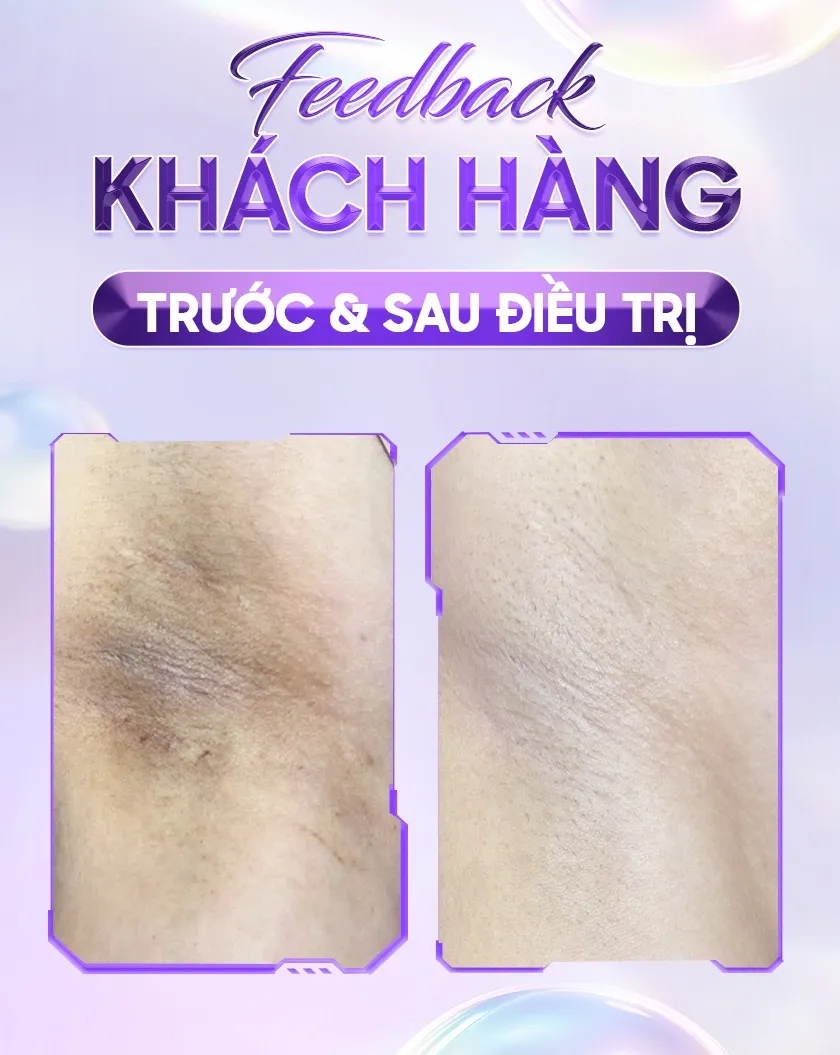 Ba ưu đãi trị thâm 03 1