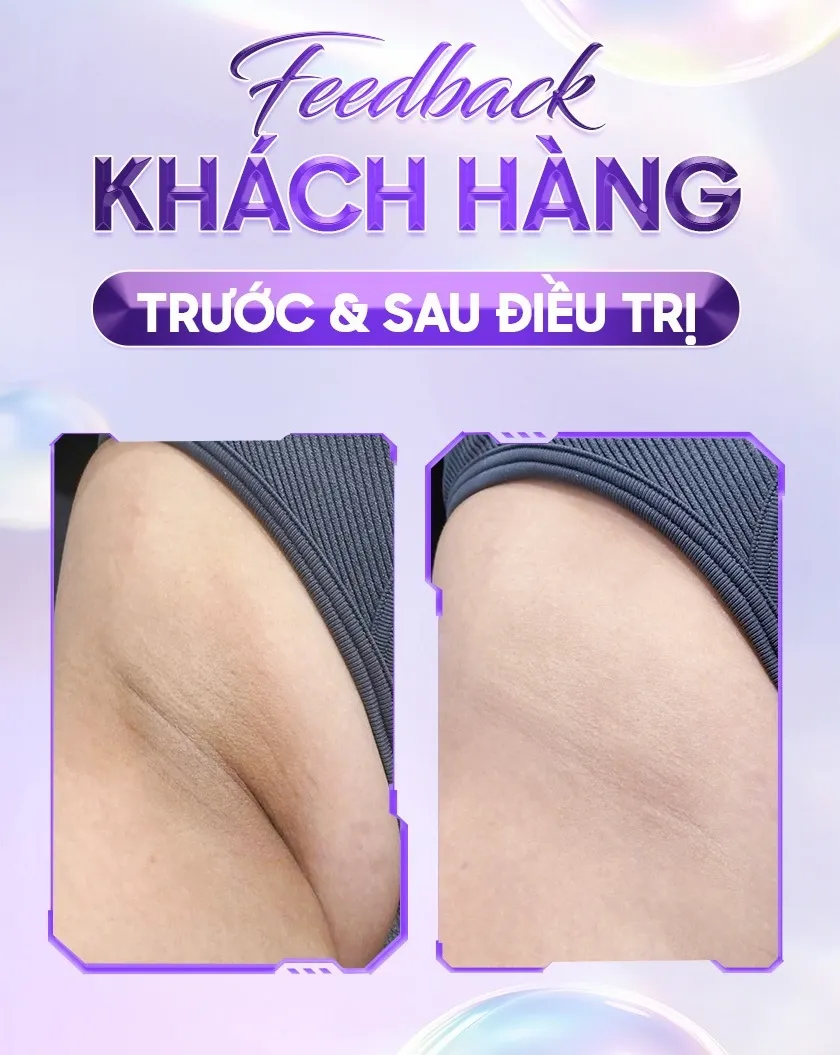 Ba ưu đãi trị thâm 05 1