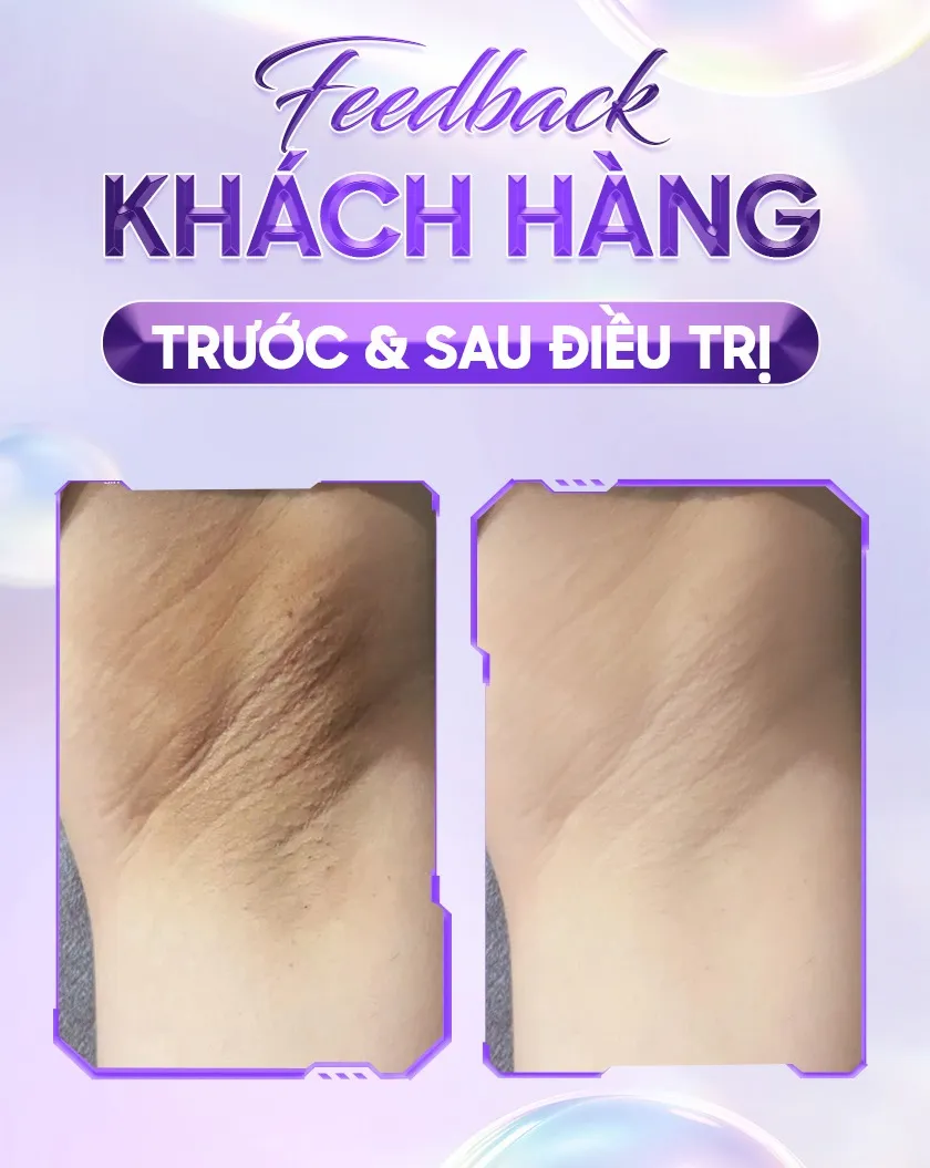 Ba ưu đãi trị thâm 07 1