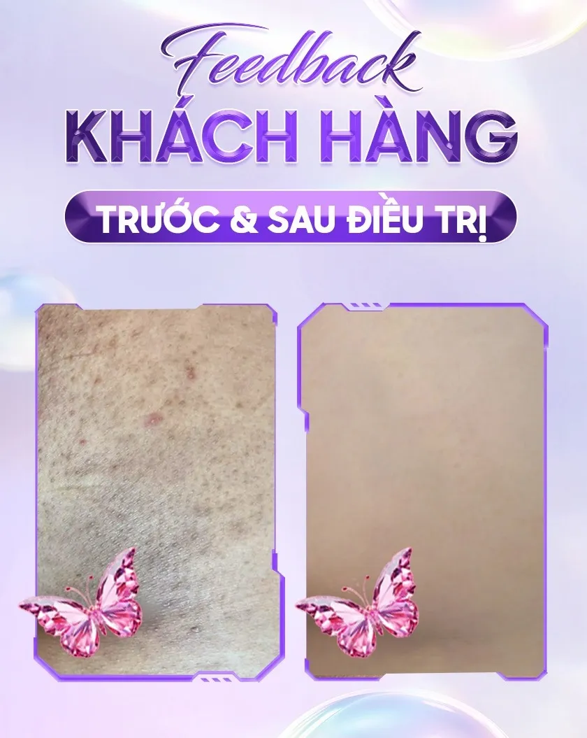 Ba ưu đãi trị thâm 08 1