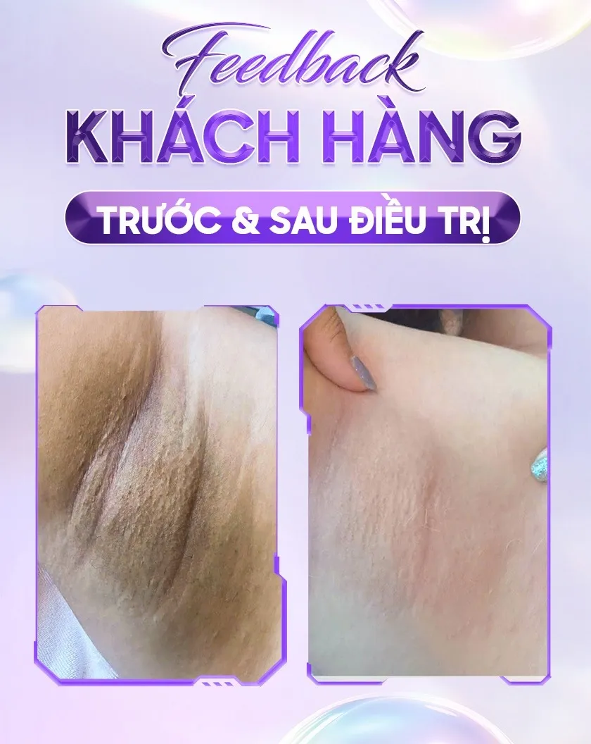 Ba ưu đãi trị thâm 09 1