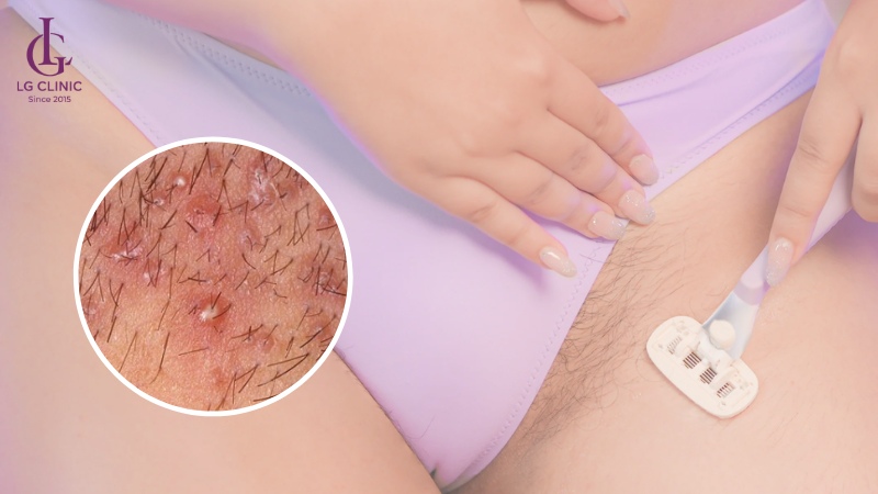 Cạo lông vùng kín bị nổi mụn 1