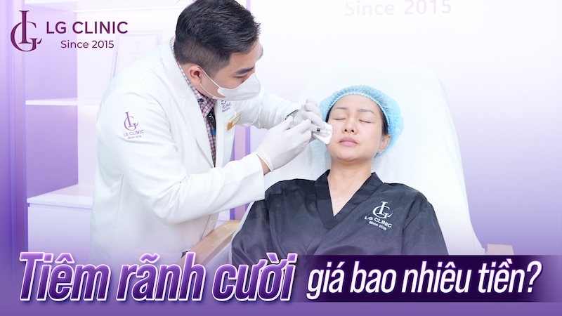 tiêm rãnh cười giá bao nhiêu