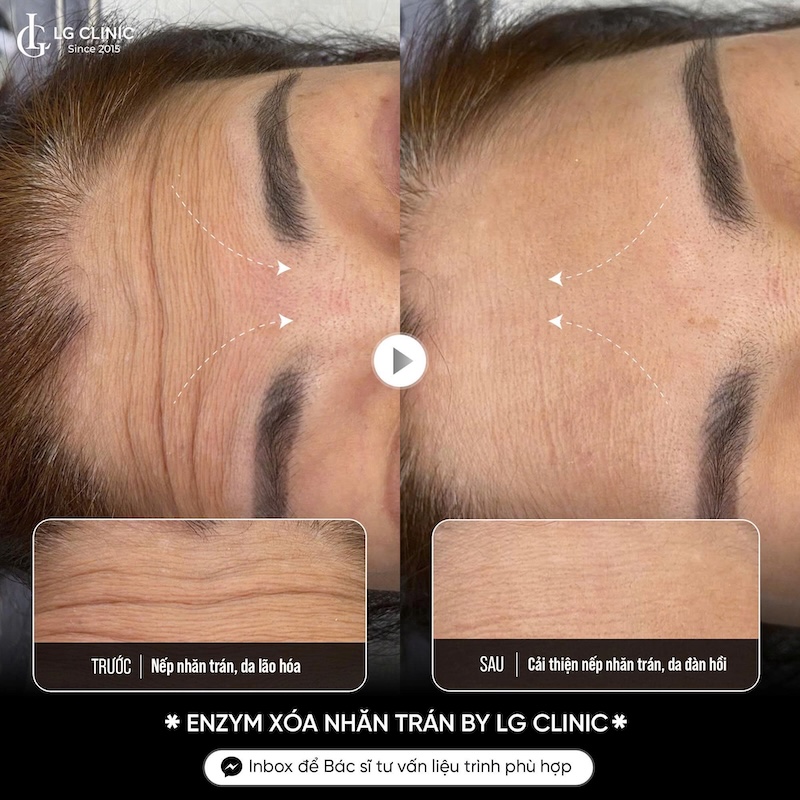 kết quả xoá nhăn trán