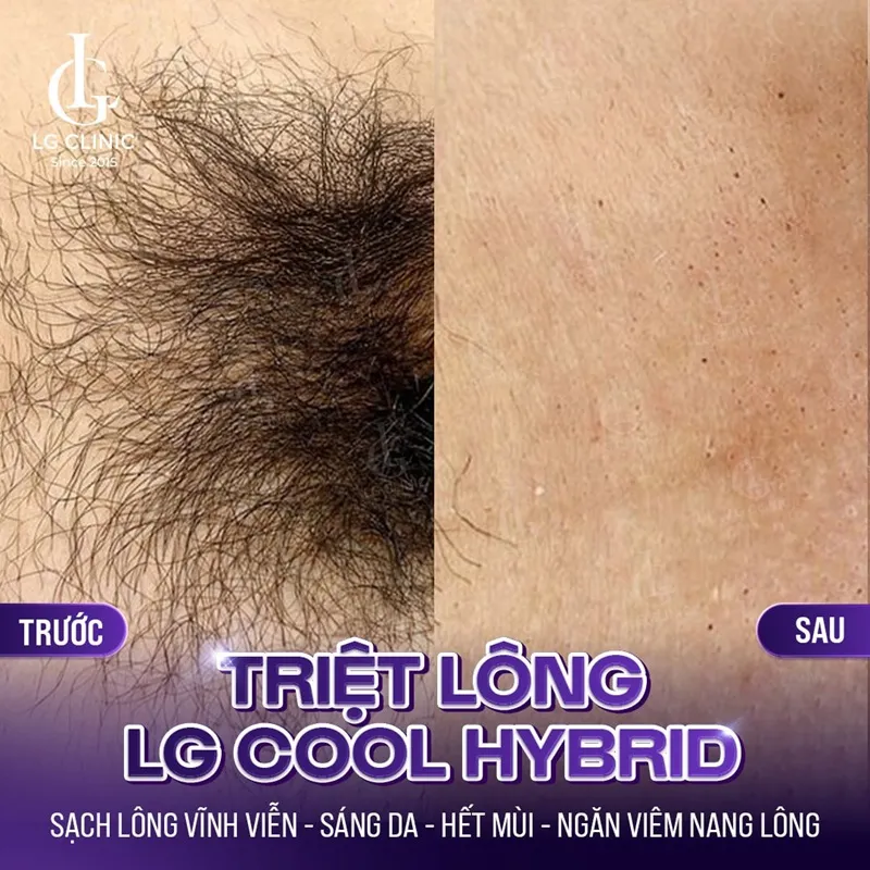 hinh anh ba triet long lg cool hybrid 01