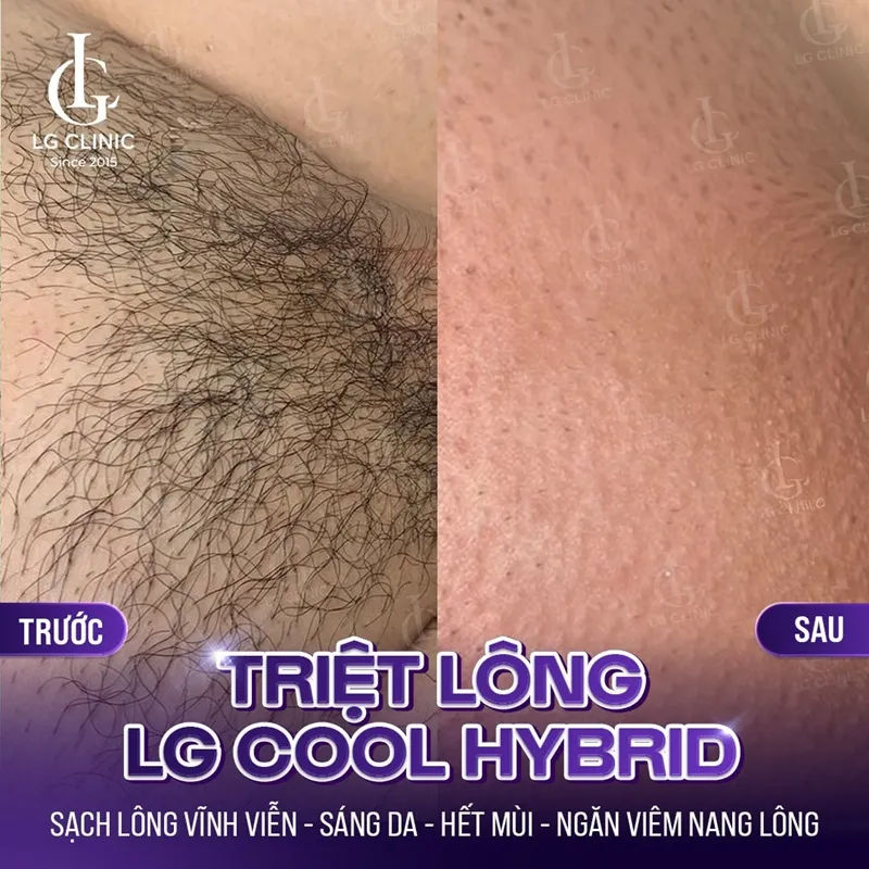 hinh anh ba triet long lg cool hybrid 02