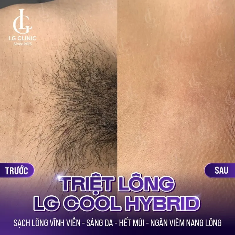 hinh anh ba triet long lg cool hybrid 03