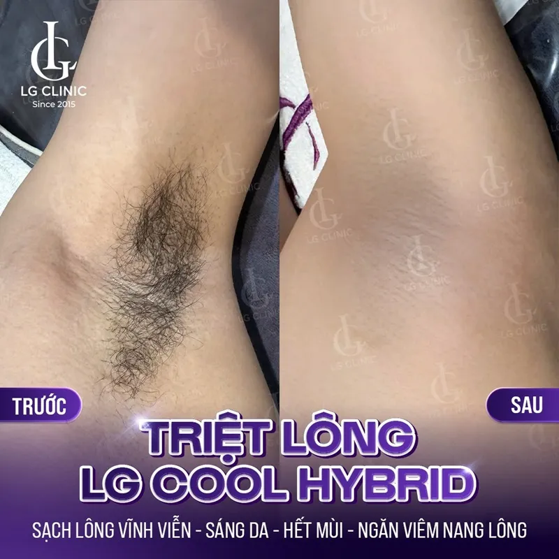 hinh anh ba triet long lg cool hybrid 04
