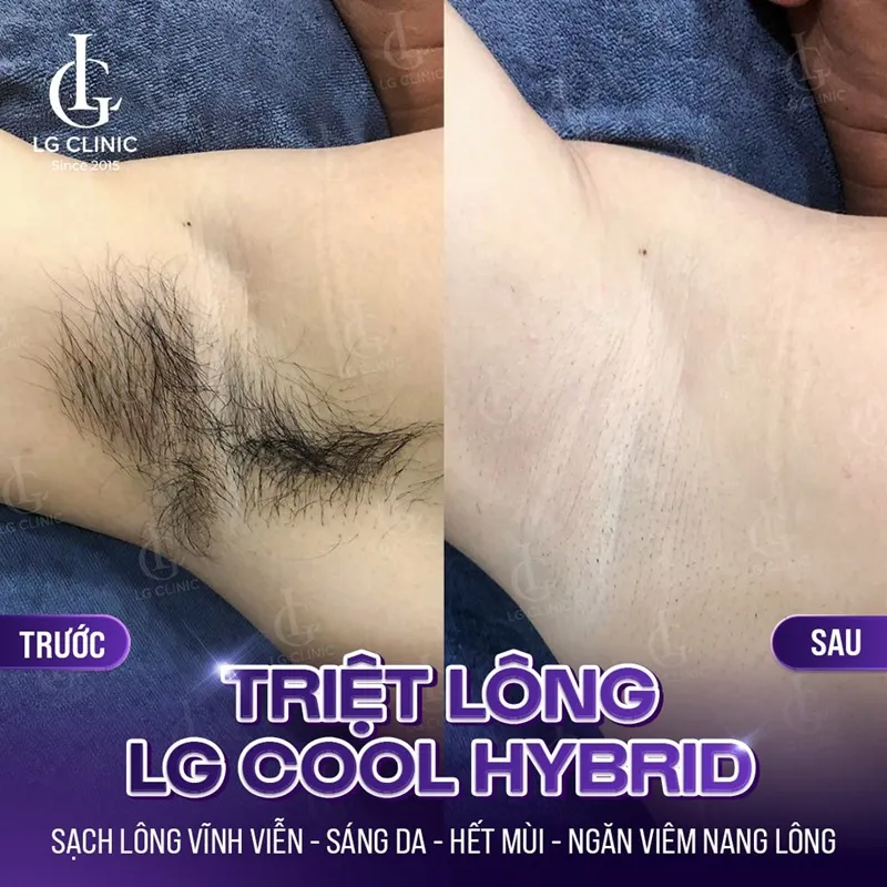 hinh anh ba triet long lg cool hybrid 05