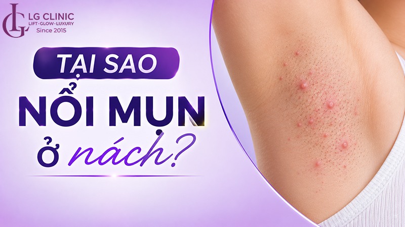 tại sao mụn nổi ở nách